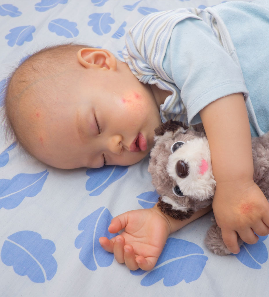Piqure de punaise de lit sur un bébé qui dort