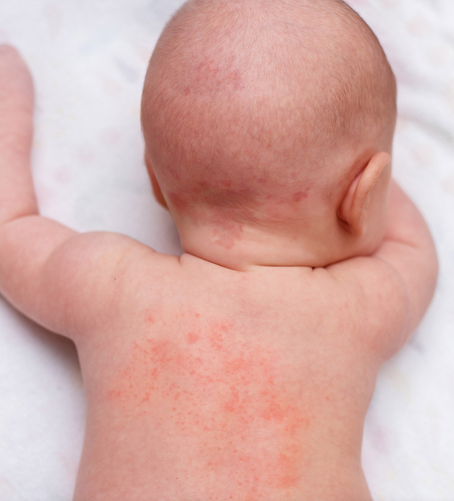 Piqures de puces de lit sur le dos d'un bébé