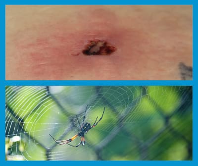 Que risque-t-on d'une piqûre d’araignée ?