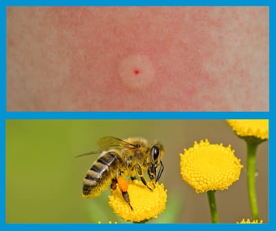 Les piqûres de guêpes et d’abeilles pour quelles conséquences