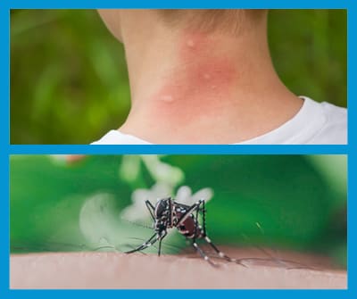 Reconnaître la piqûre de moustique
