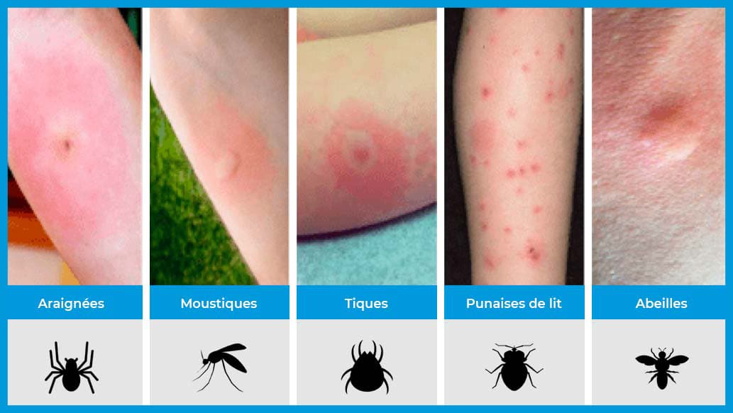 Punaises de lit et traitement de la peau