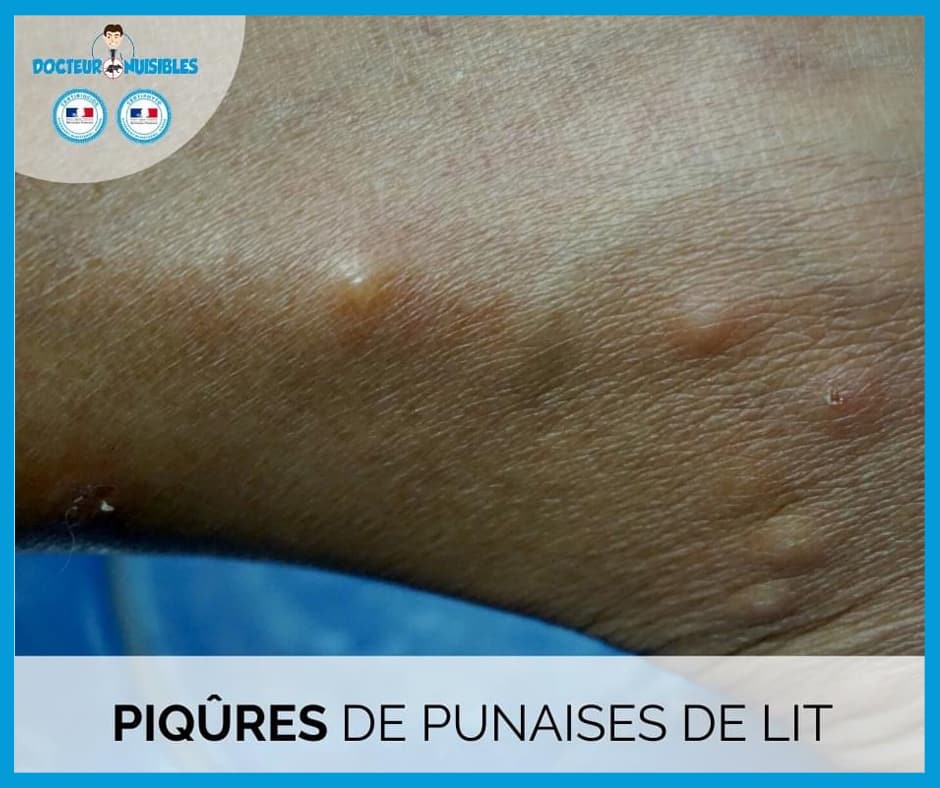 Que faut-il faire en cas de morsure de punaises  ?