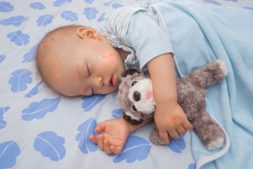 Photo de piqûres de punaises de lit sur un bébé
