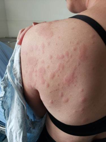 Photo de piqûres de punaises de lit sur le dos